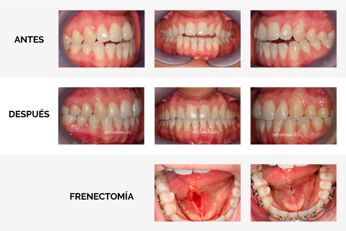Frenectomia Lingual Conventional Frenectomy With Topical Ozonated Oil Frenectomia Lingual Conventional Frenectomy With Topical Ozonated Oil